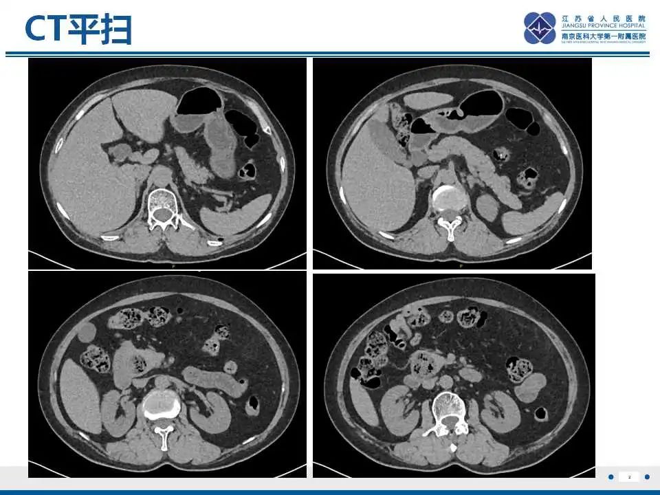 影像PPT - 【PPT】十二指肠乳头旁憩室综合征-3
