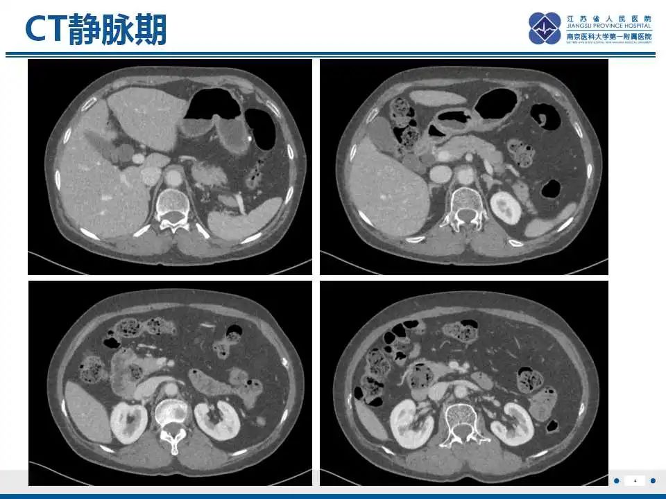 影像PPT - 【PPT】十二指肠乳头旁憩室综合征-5