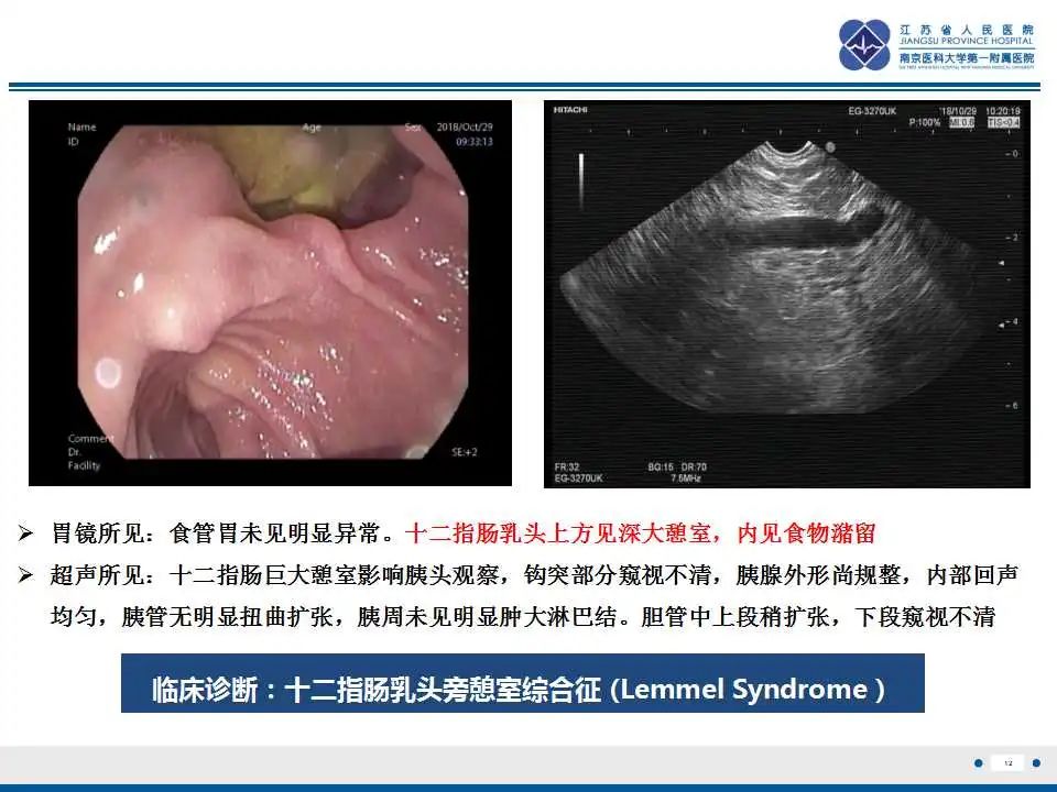 影像PPT - 【PPT】十二指肠乳头旁憩室综合征-13