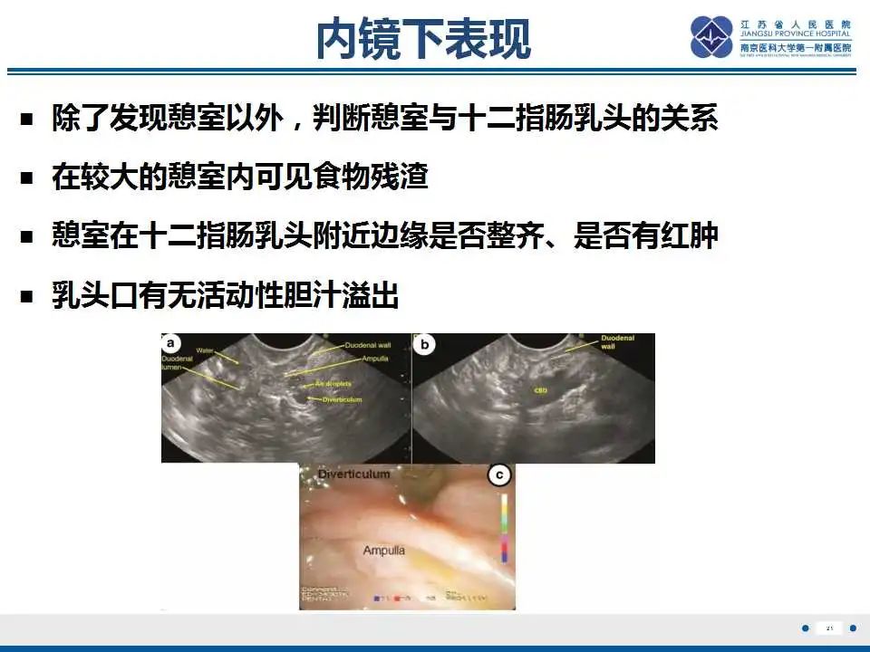 影像PPT - 【PPT】十二指肠乳头旁憩室综合征-22