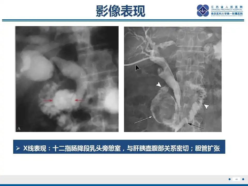 影像PPT - 【PPT】十二指肠乳头旁憩室综合征-24