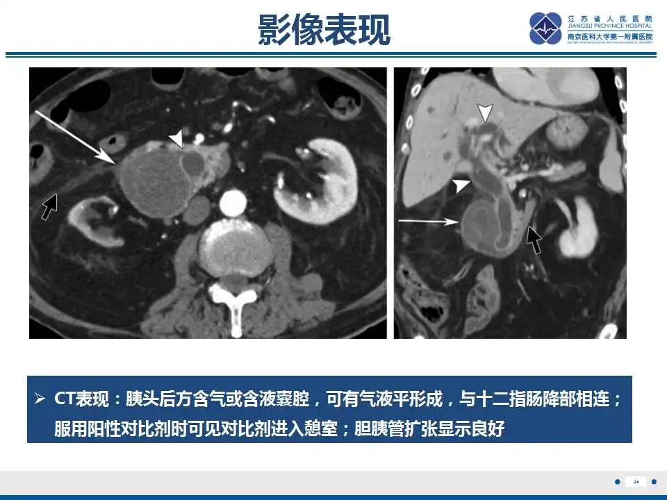 影像PPT - 【PPT】十二指肠乳头旁憩室综合征-25