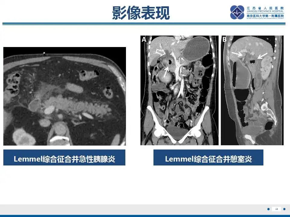 影像PPT - 【PPT】十二指肠乳头旁憩室综合征-26