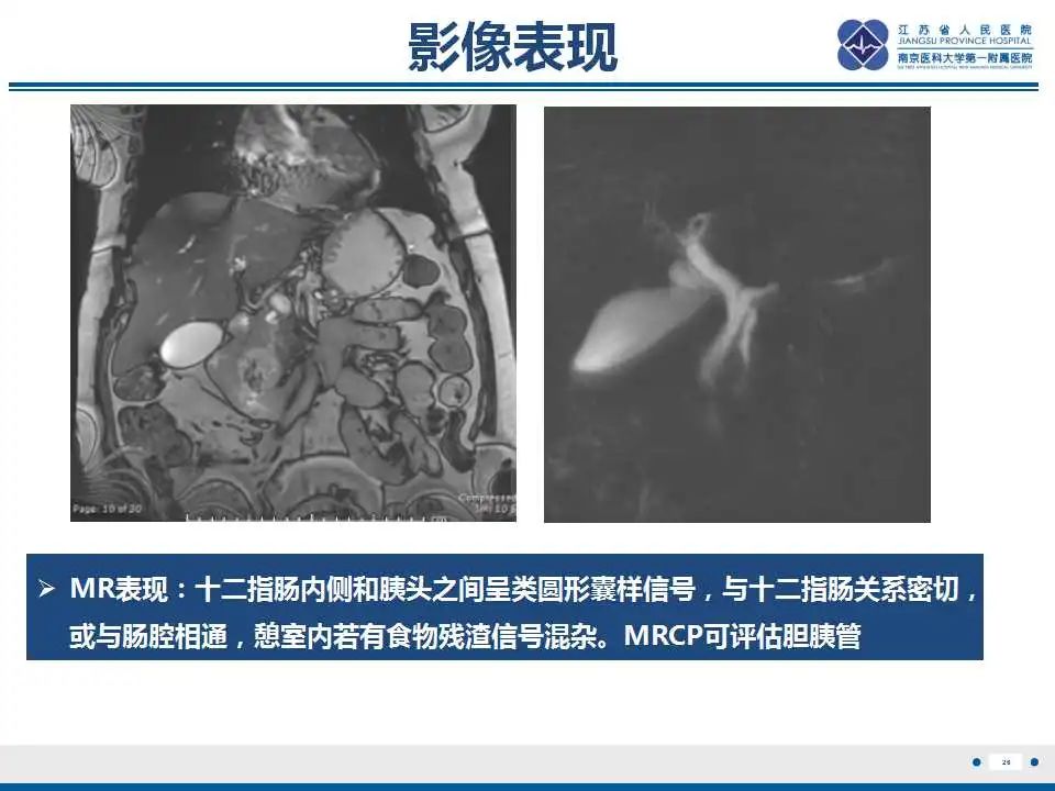 影像PPT - 【PPT】十二指肠乳头旁憩室综合征-27