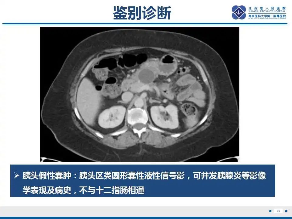 影像PPT - 【PPT】十二指肠乳头旁憩室综合征-30