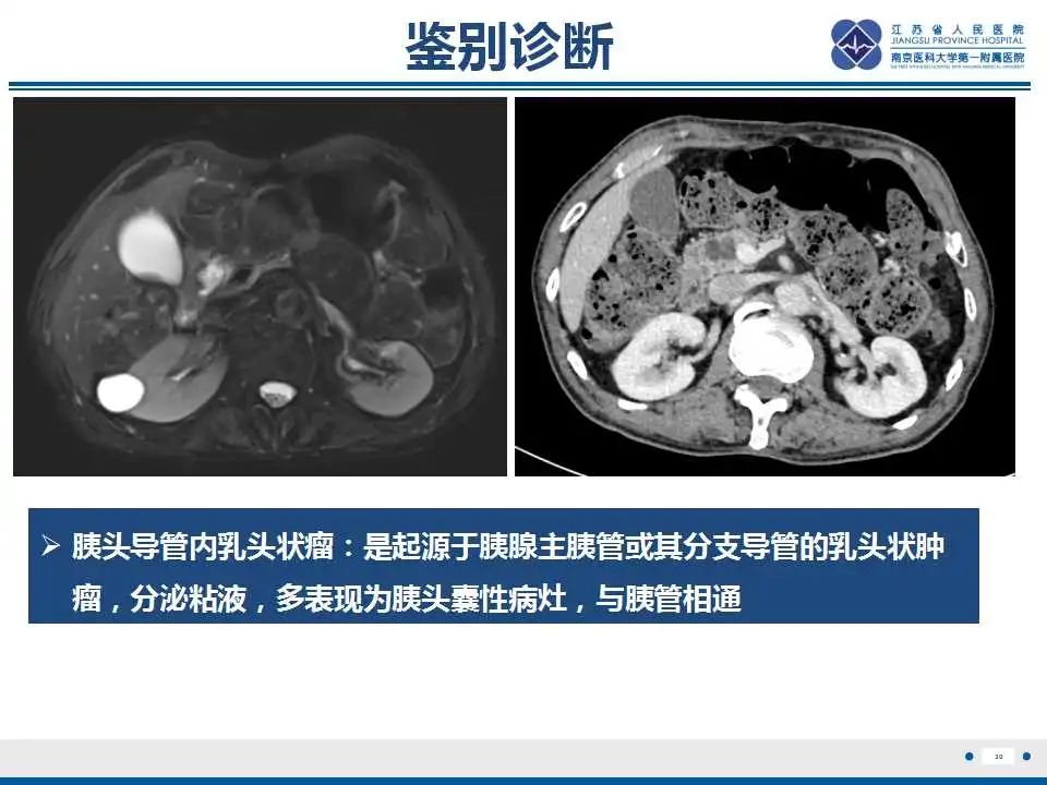 影像PPT - 【PPT】十二指肠乳头旁憩室综合征-31