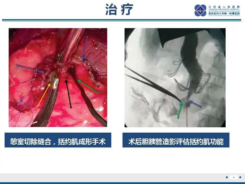 影像PPT - 【PPT】十二指肠乳头旁憩室综合征-33