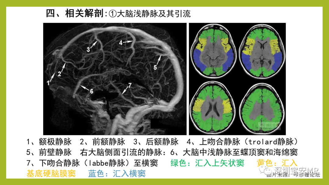 影像PPT - 【PPT】Sturge-Weber 综合征-4