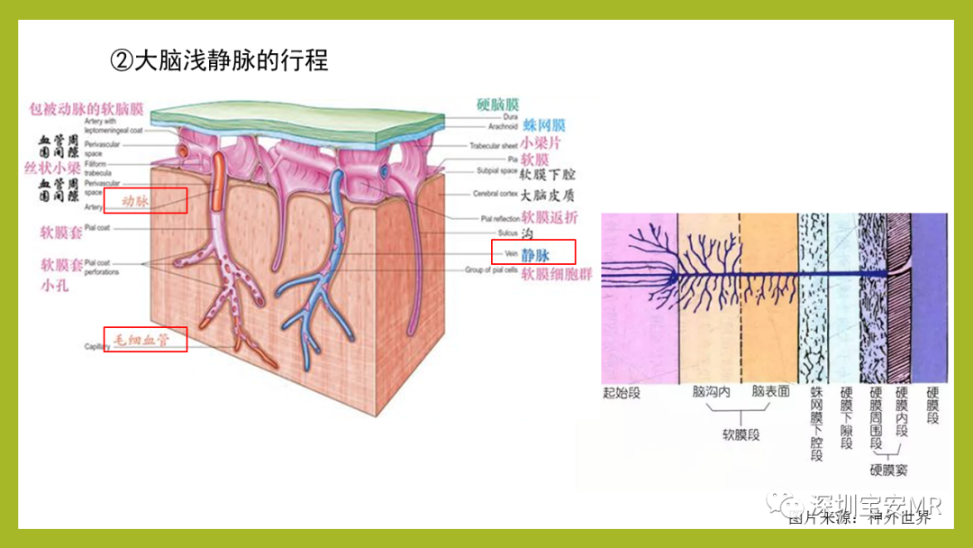影像PPT - 【PPT】Sturge-Weber 综合征-5