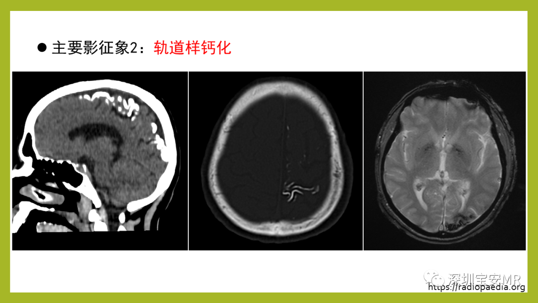 影像PPT - 【PPT】Sturge-Weber 综合征-10