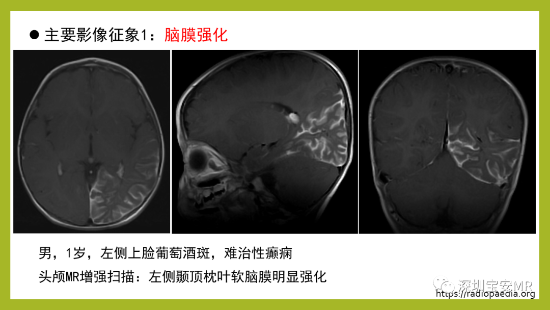 影像PPT - 【PPT】Sturge-Weber 综合征-8