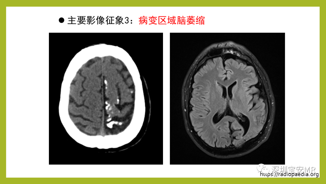 影像PPT - 【PPT】Sturge-Weber 综合征-11