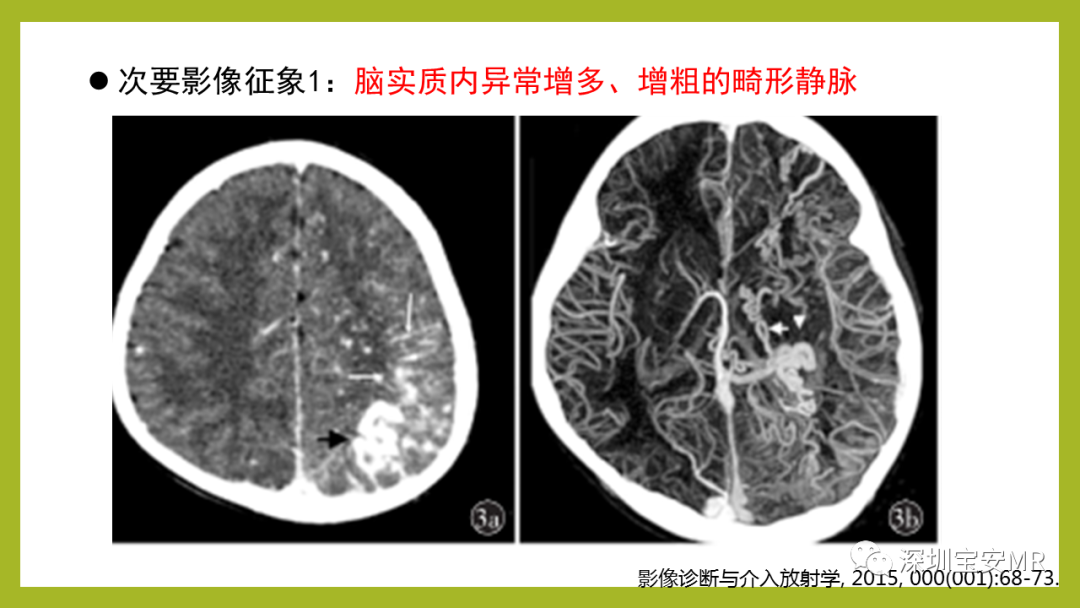 影像PPT - 【PPT】Sturge-Weber 综合征-12
