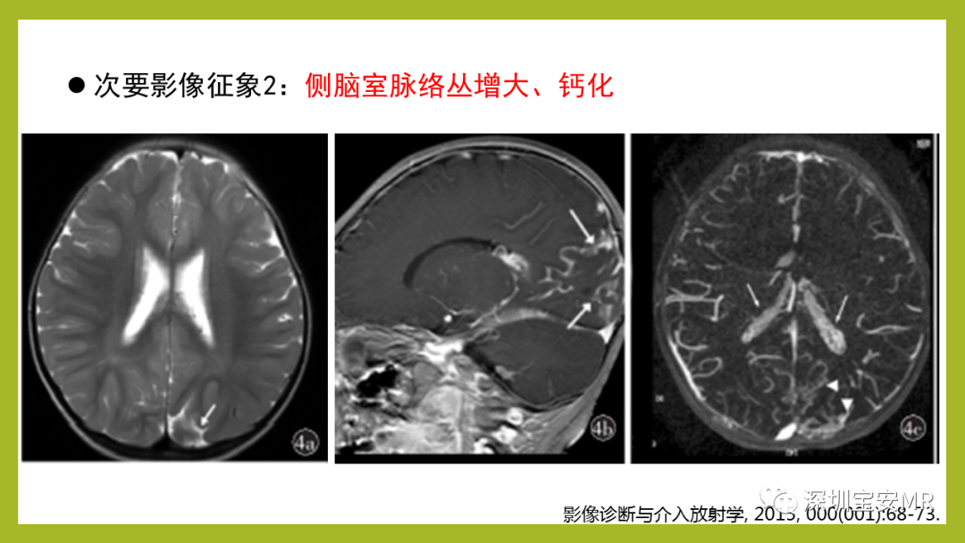 影像PPT - 【PPT】Sturge-Weber 综合征-13