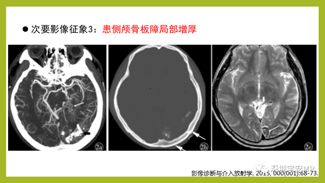 影像PPT - 【PPT】Sturge-Weber 综合征-14