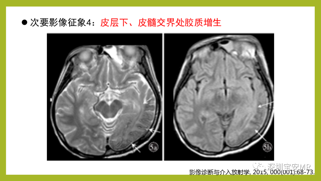 影像PPT - 【PPT】Sturge-Weber 综合征-15