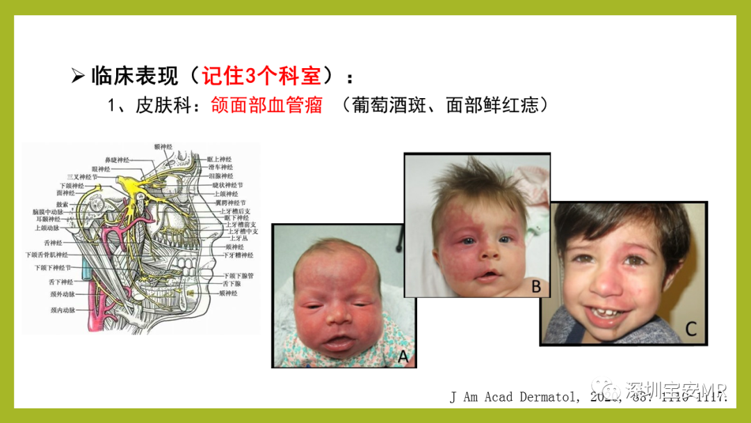 影像PPT - 【PPT】Sturge-Weber 综合征-17