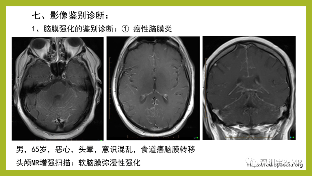 影像PPT - 【PPT】Sturge-Weber 综合征-21