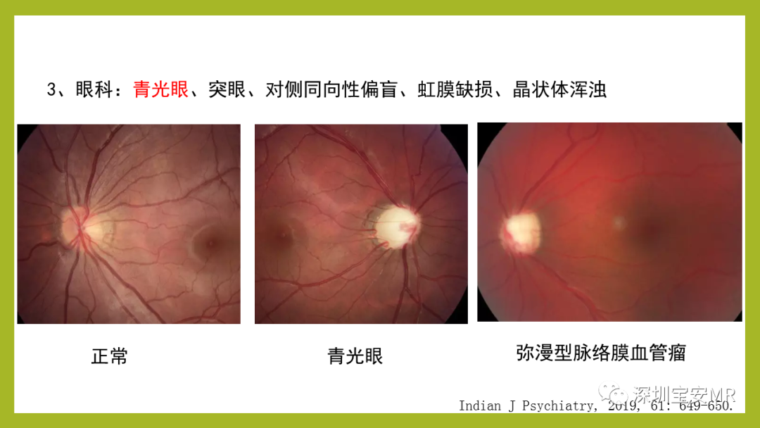 影像PPT - 【PPT】Sturge-Weber 综合征-19