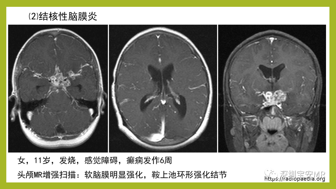 影像PPT - 【PPT】Sturge-Weber 综合征-23