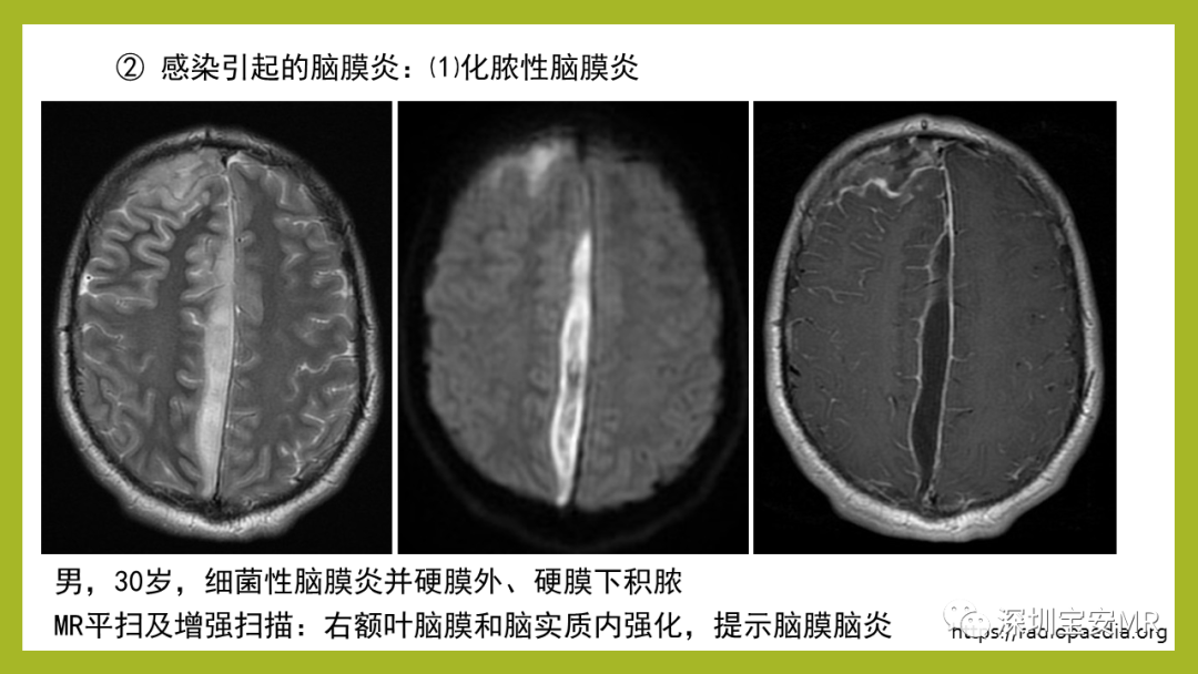 影像PPT - 【PPT】Sturge-Weber 综合征-22
