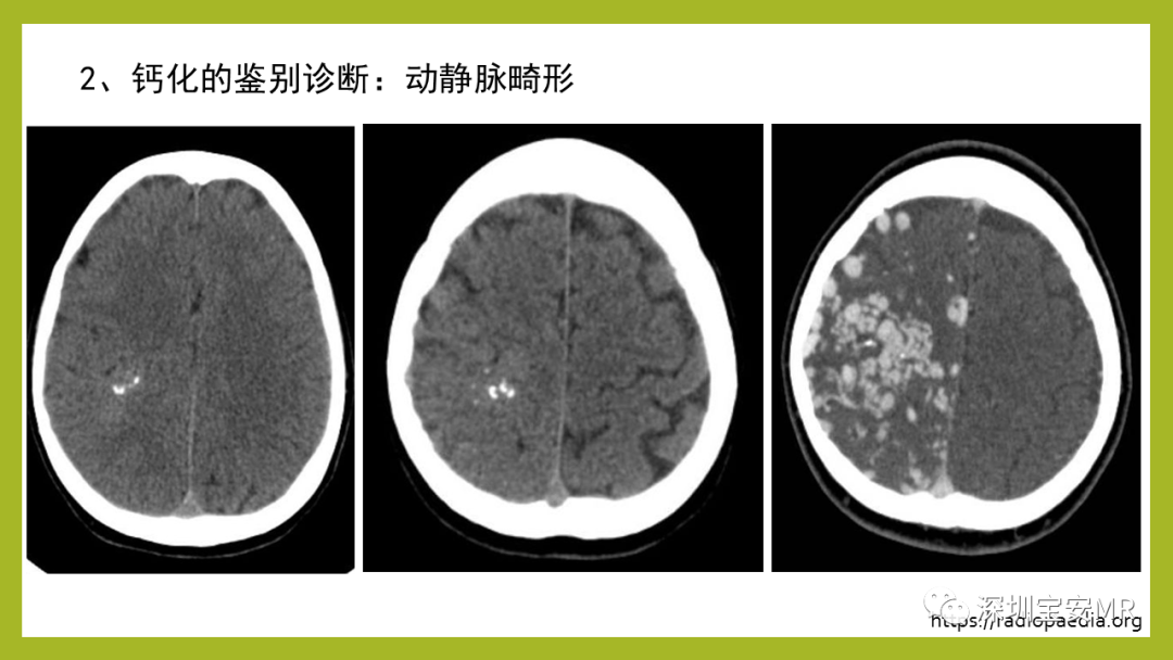 影像PPT - 【PPT】Sturge-Weber 综合征-24