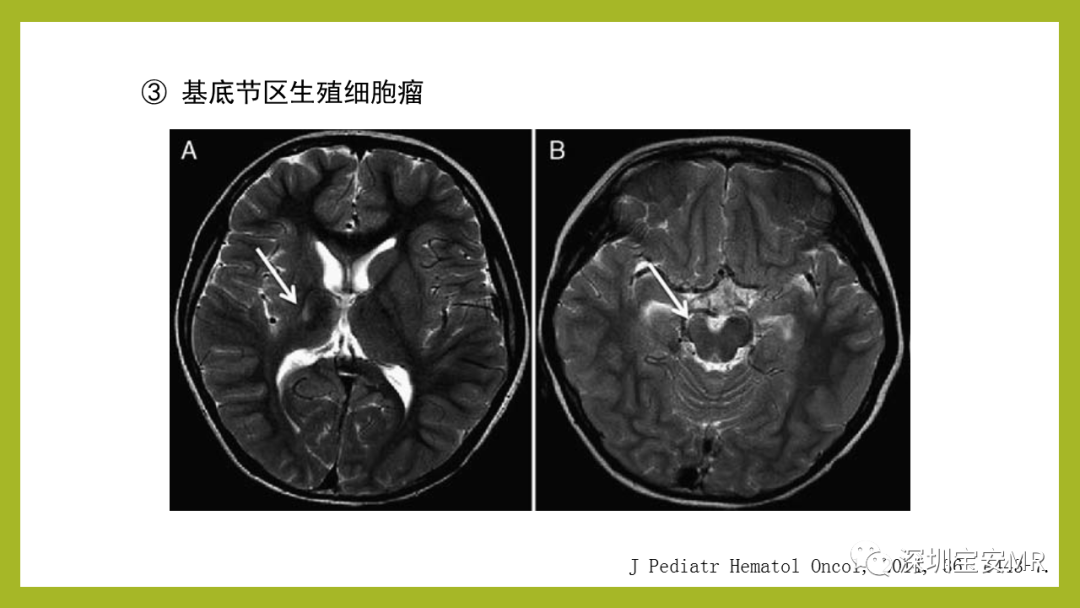 影像PPT - 【PPT】Sturge-Weber 综合征-27