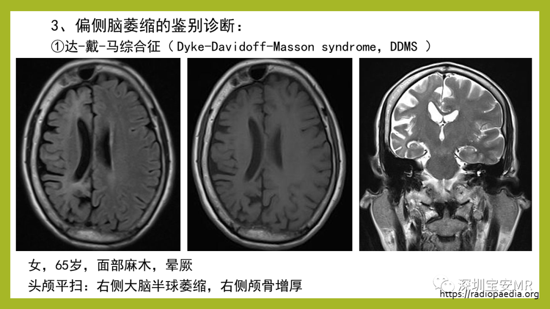 影像PPT - 【PPT】Sturge-Weber 综合征-25