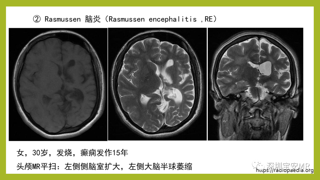 影像PPT - 【PPT】Sturge-Weber 综合征-26