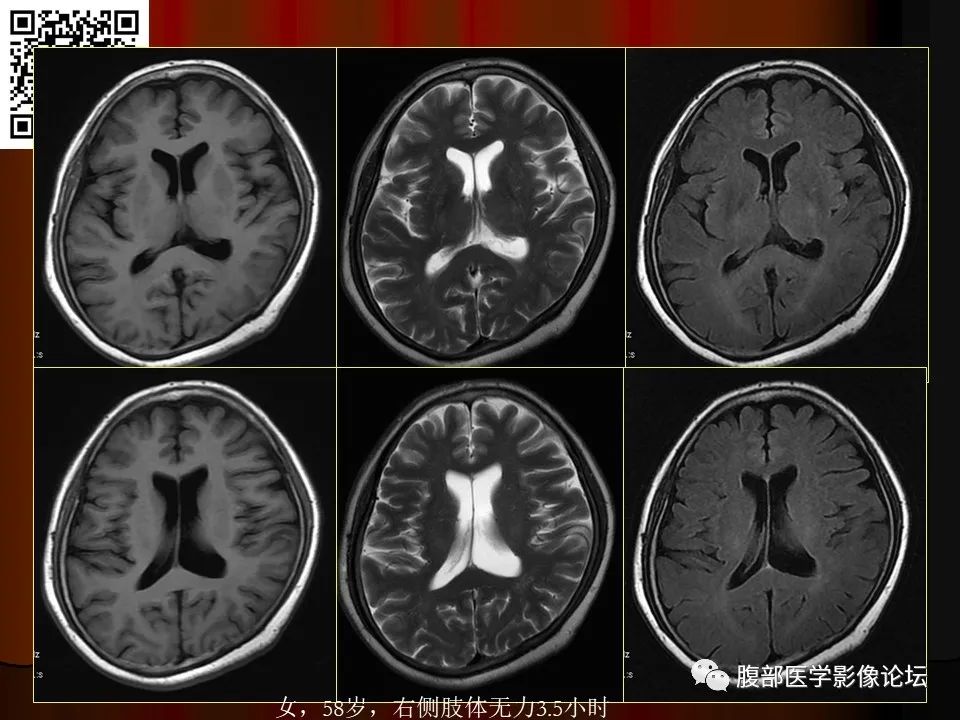 影像PPT - 【PPT】基于DWI的公式法对脑梗死病情进展的评估作用-19