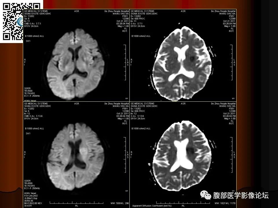 影像PPT - 【PPT】基于DWI的公式法对脑梗死病情进展的评估作用-20