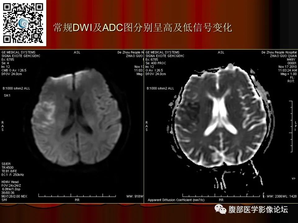 影像PPT - 【PPT】基于DWI的公式法对脑梗死病情进展的评估作用-22