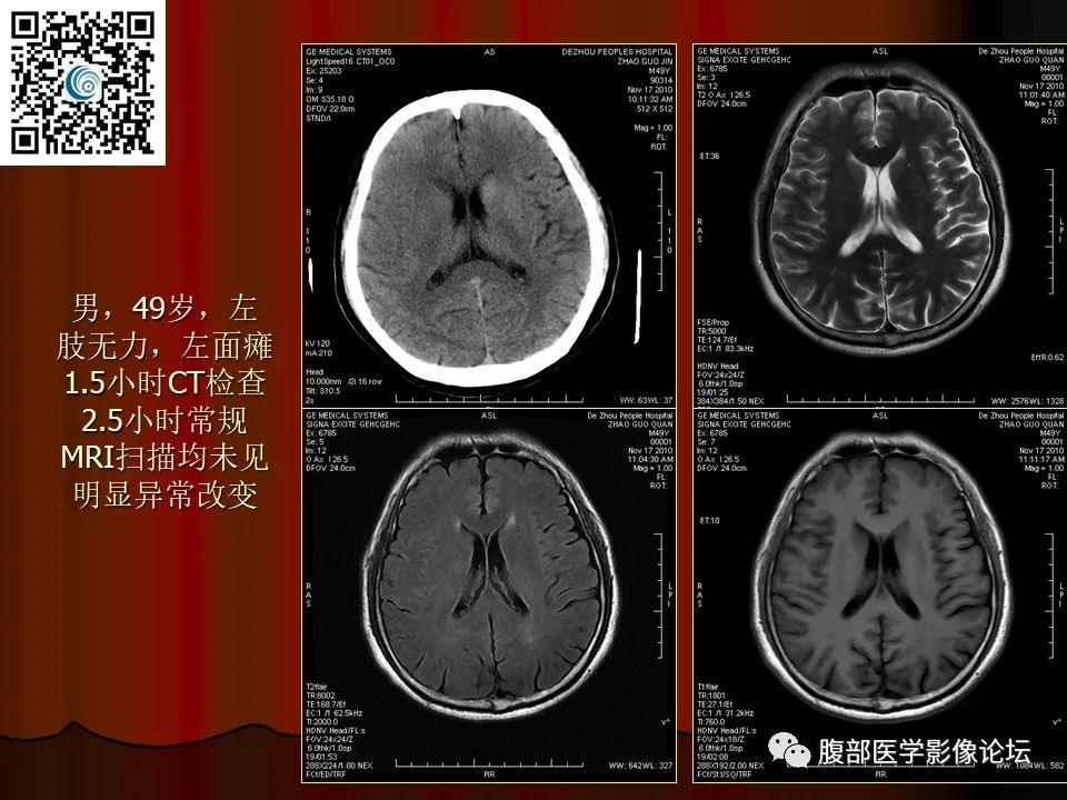 影像PPT - 【PPT】基于DWI的公式法对脑梗死病情进展的评估作用-21