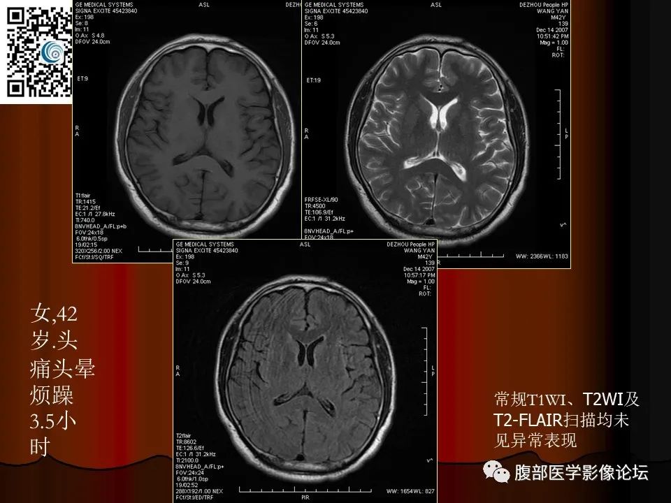影像PPT - 【PPT】基于DWI的公式法对脑梗死病情进展的评估作用-23
