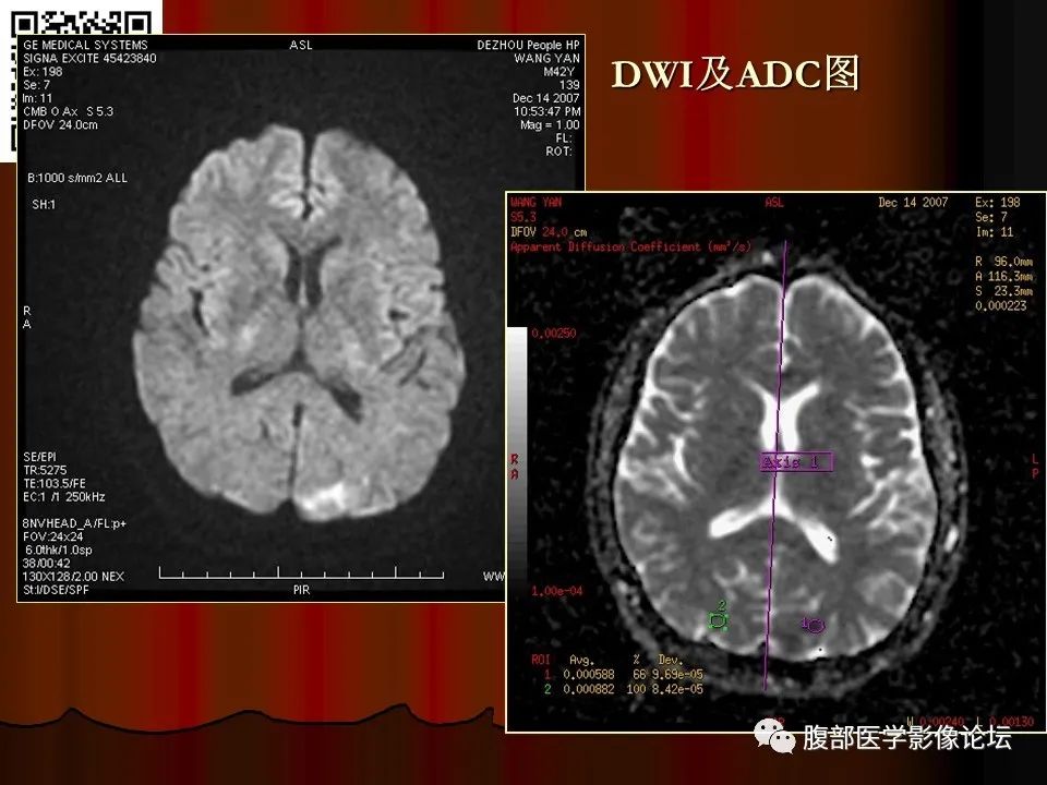 影像PPT - 【PPT】基于DWI的公式法对脑梗死病情进展的评估作用-24