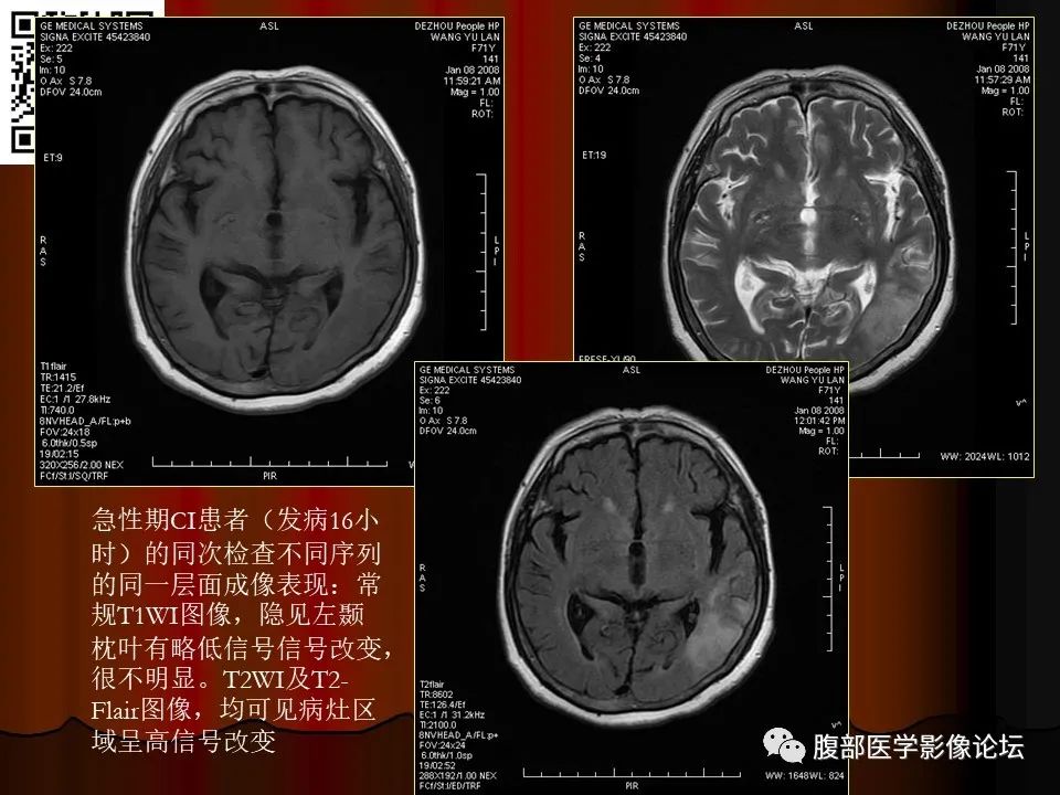 影像PPT - 【PPT】基于DWI的公式法对脑梗死病情进展的评估作用-32