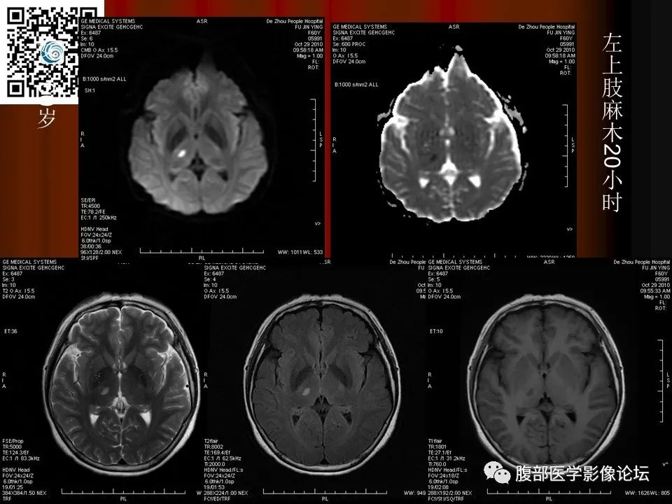 影像PPT - 【PPT】基于DWI的公式法对脑梗死病情进展的评估作用-34