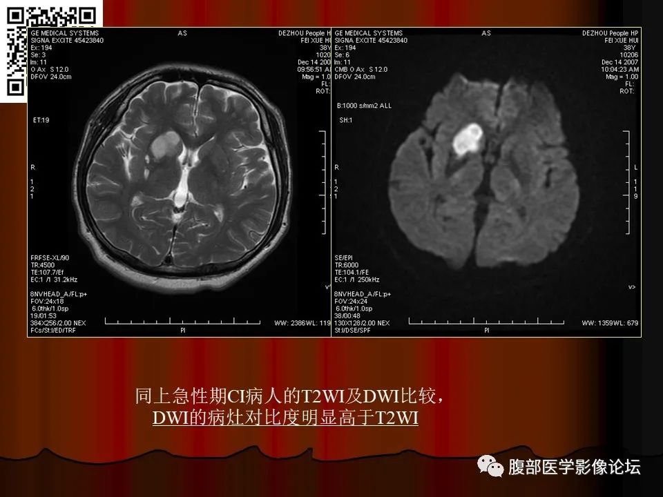 影像PPT - 【PPT】基于DWI的公式法对脑梗死病情进展的评估作用-36