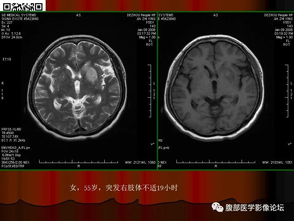 影像PPT - 【PPT】基于DWI的公式法对脑梗死病情进展的评估作用-37