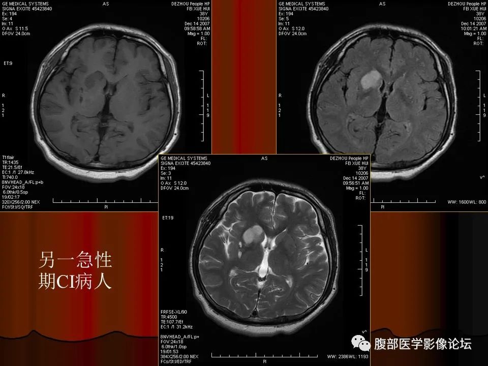 影像PPT - 【PPT】基于DWI的公式法对脑梗死病情进展的评估作用-35