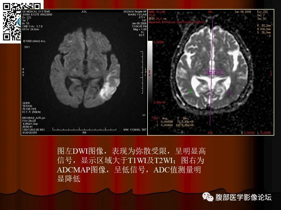 影像PPT - 【PPT】基于DWI的公式法对脑梗死病情进展的评估作用-33