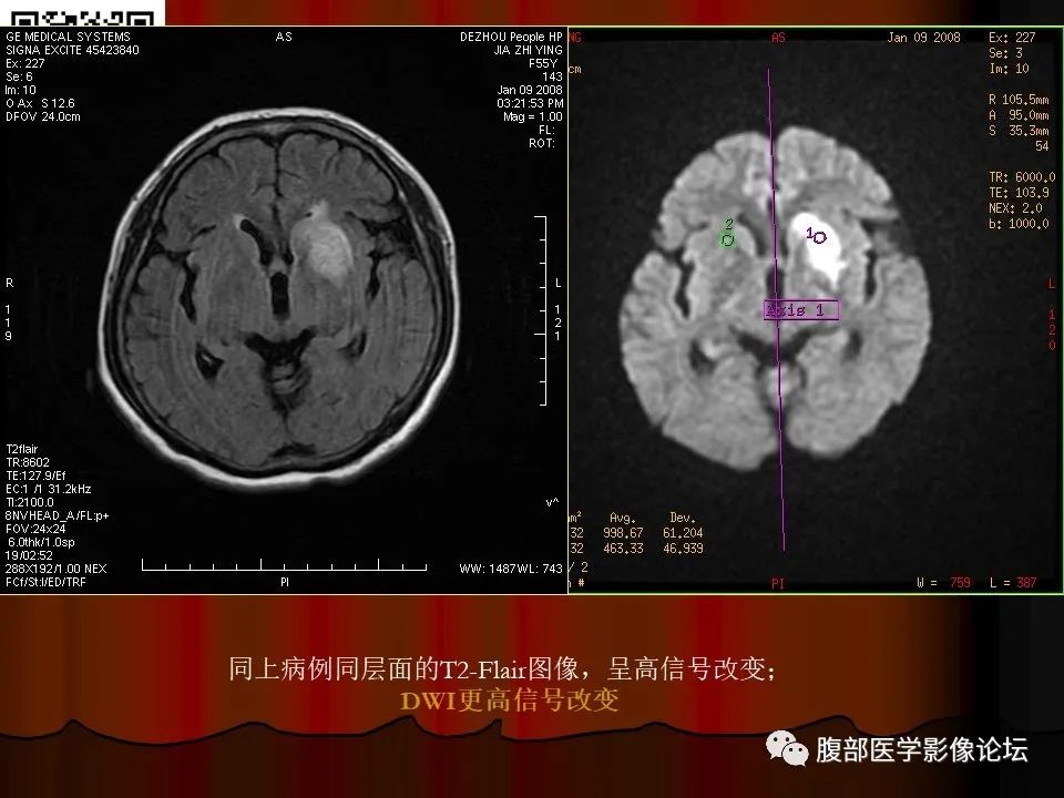 影像PPT - 【PPT】基于DWI的公式法对脑梗死病情进展的评估作用-38