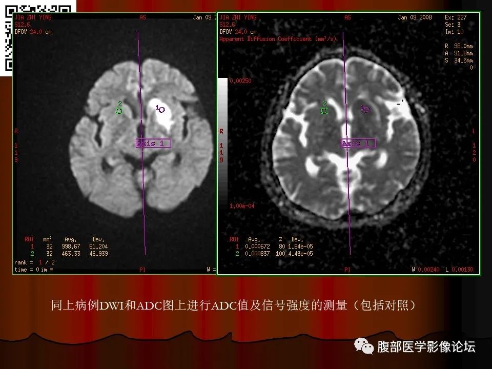 影像PPT - 【PPT】基于DWI的公式法对脑梗死病情进展的评估作用-39