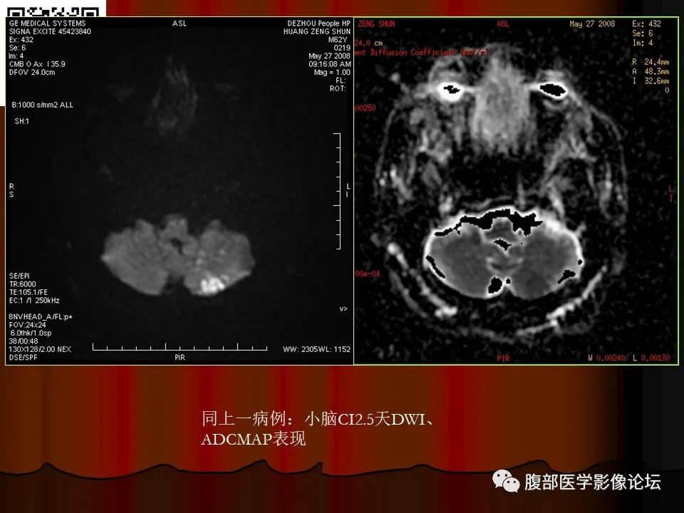 影像PPT - 【PPT】基于DWI的公式法对脑梗死病情进展的评估作用-47