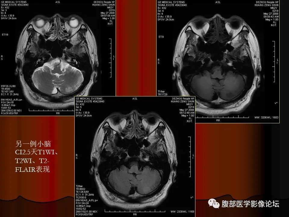 影像PPT - 【PPT】基于DWI的公式法对脑梗死病情进展的评估作用-46