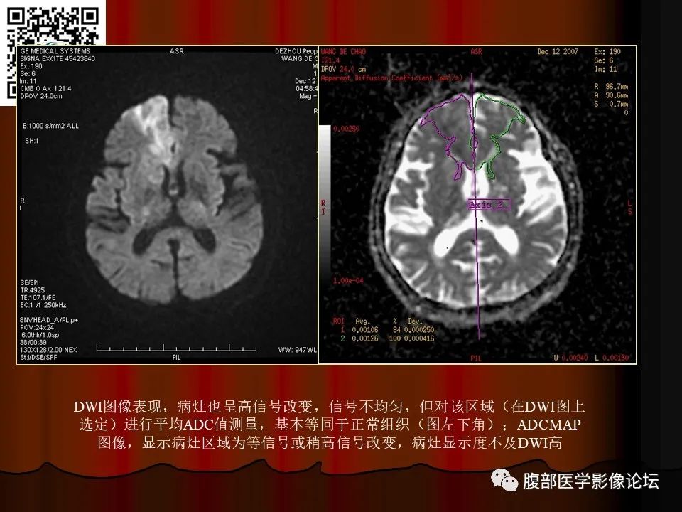 影像PPT - 【PPT】基于DWI的公式法对脑梗死病情进展的评估作用-49