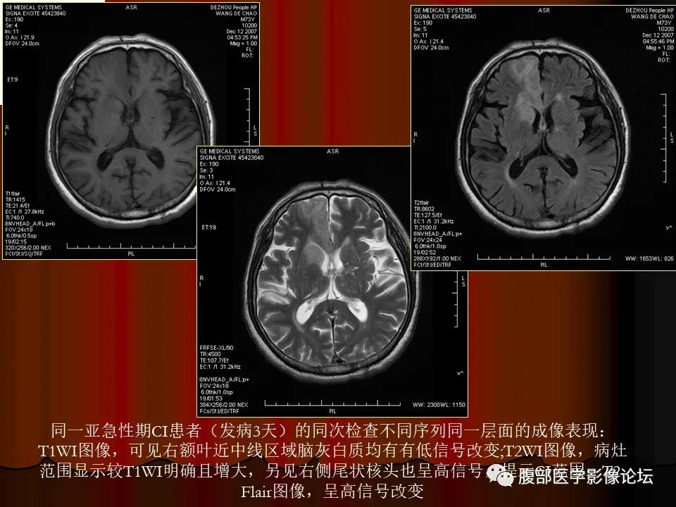影像PPT - 【PPT】基于DWI的公式法对脑梗死病情进展的评估作用-48