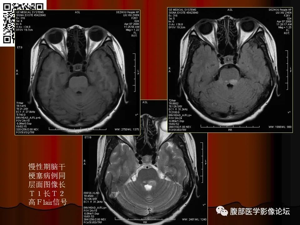 影像PPT - 【PPT】基于DWI的公式法对脑梗死病情进展的评估作用-53