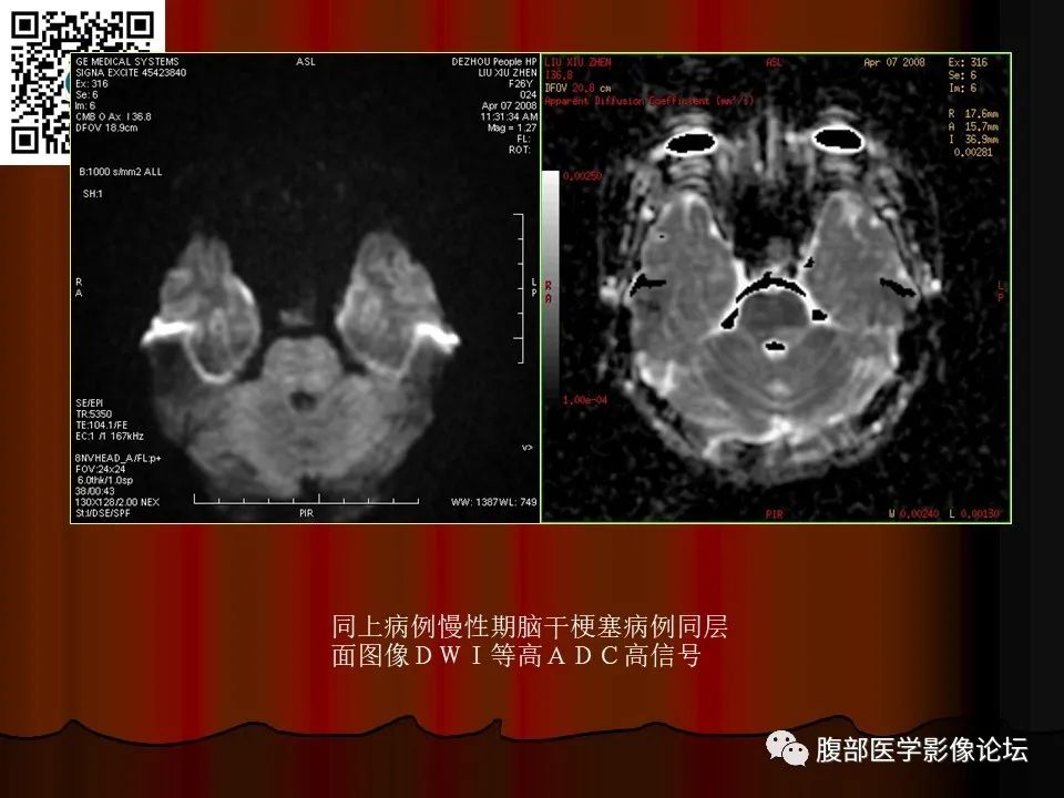 影像PPT - 【PPT】基于DWI的公式法对脑梗死病情进展的评估作用-54