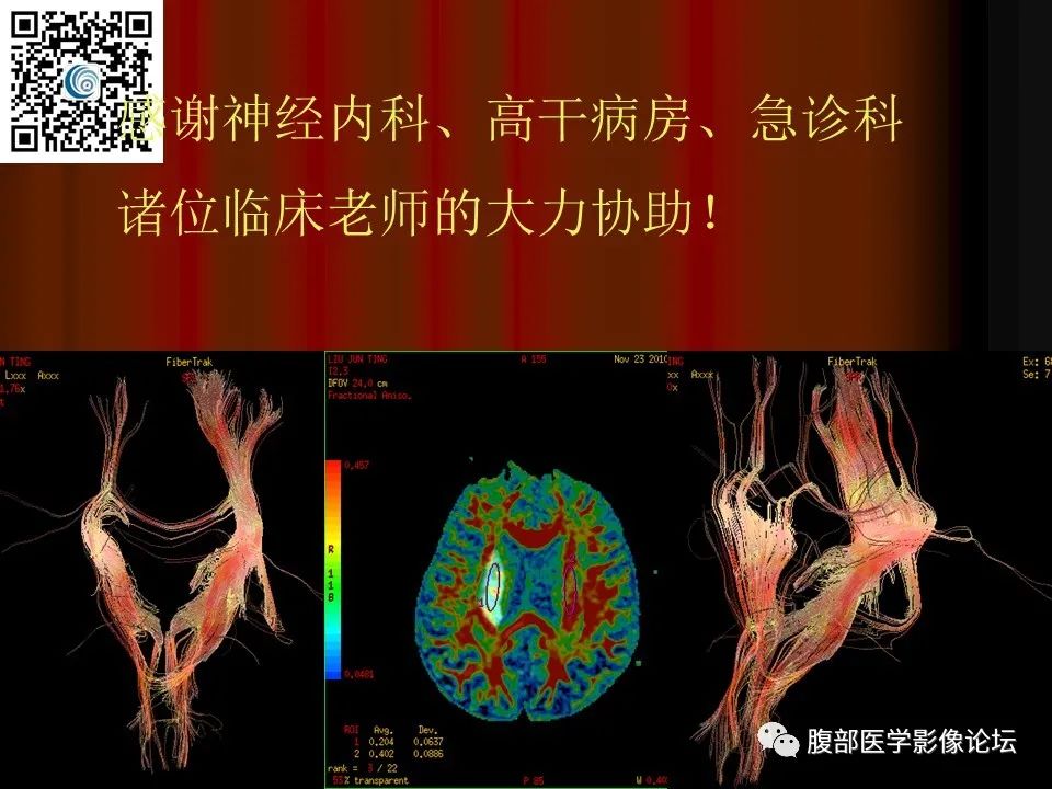 影像PPT - 【PPT】基于DWI的公式法对脑梗死病情进展的评估作用-85
